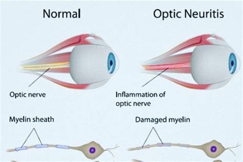 What Autoimmune Disease Cause Optic Neuritis